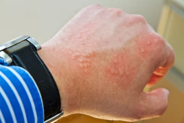Alergia, espinha ou monkeypox? Aprenda diferenças das lesões de pele