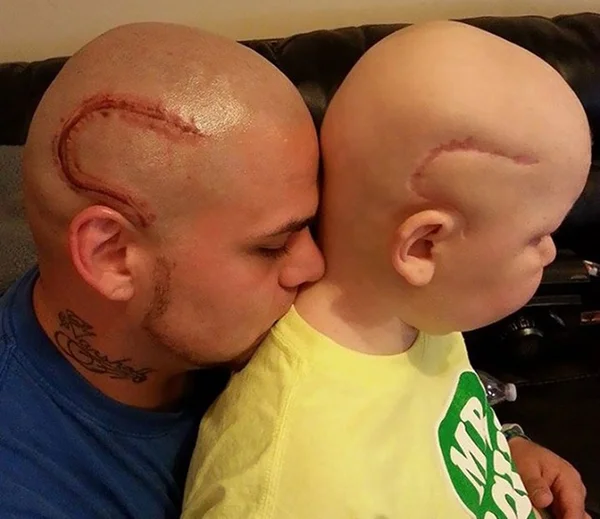 Pai tatua cicatriz igual à do filho com câncer cerebral