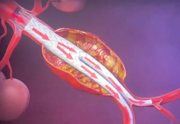 Catéter para cirurgia de aneurisma