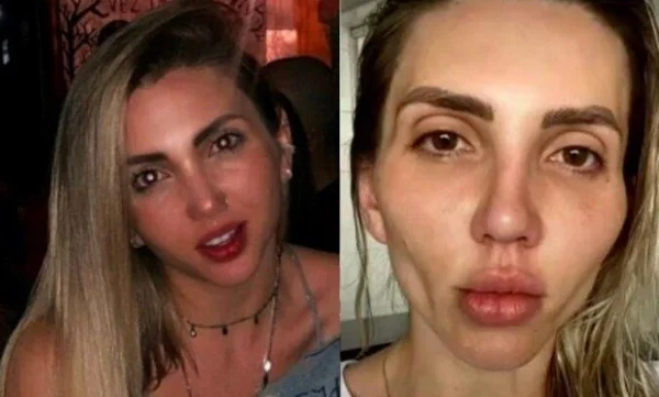 Influencer se arrepende de procedimento. Foto do antes e depois