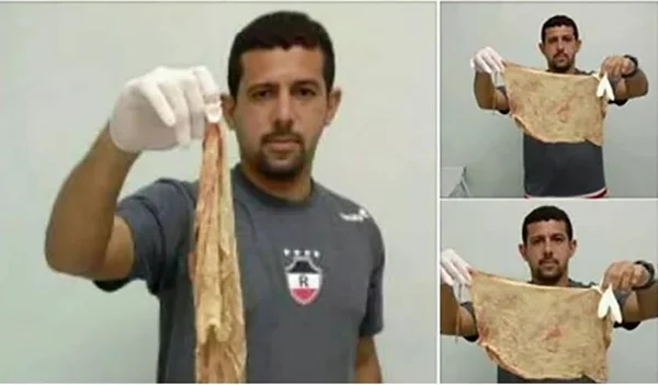 De tapioca a ovo: saiba o que não passar nas assaduras do neném