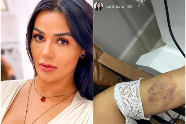 Influenciadora digital posta foto de hematomas e acusa o namorado