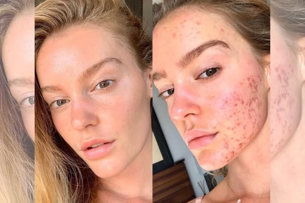 modelo com acne