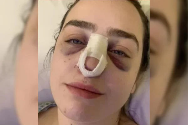 Mulher alvo de cabeçada diz que agressor teve “intenção de machucar”