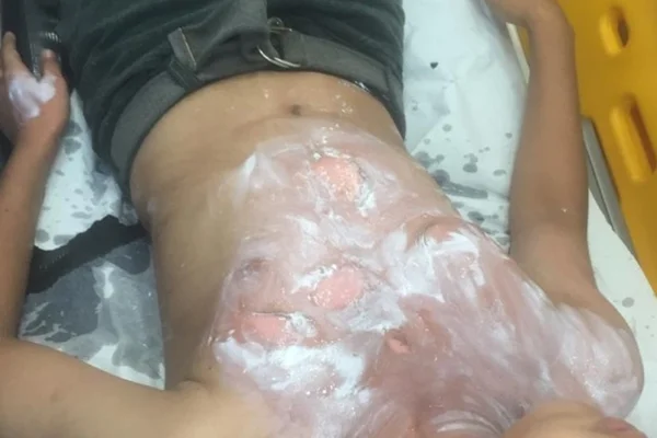 Homem joga água quente em menino de 12 anos e é preso em Manaus