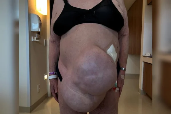 Hernia abdominal 13 anos paciente cirurgia (4)