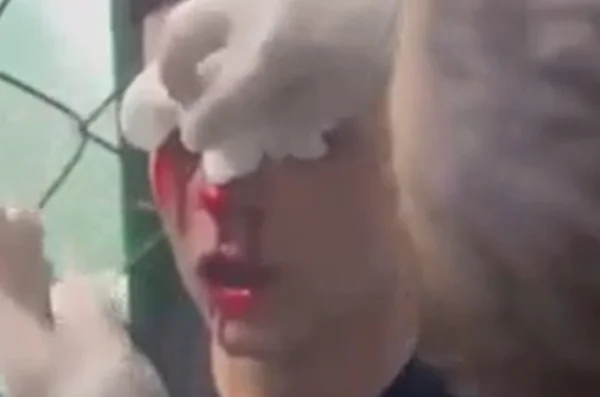 Foto colorida de jogador com olho perfurado - Metrópoles
