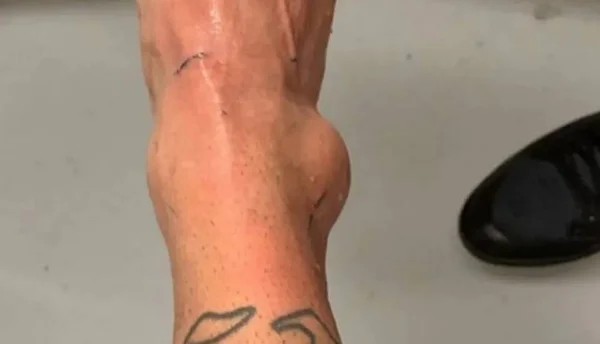 Após corte da Copa América, Neymar divulga foto do tornozelo inchado