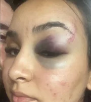 Foto de Letícia Oliveira, funcionária de quiosque da WePink, após agressão Foto de Letícia Oliveira, funcionária de quiosque da WePink, após agressão