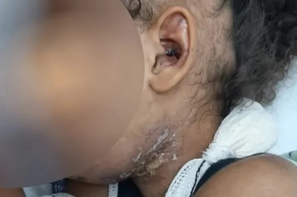 Menina de 4 anos é vítima de tortura em Aparecida de Goiânia (GO)