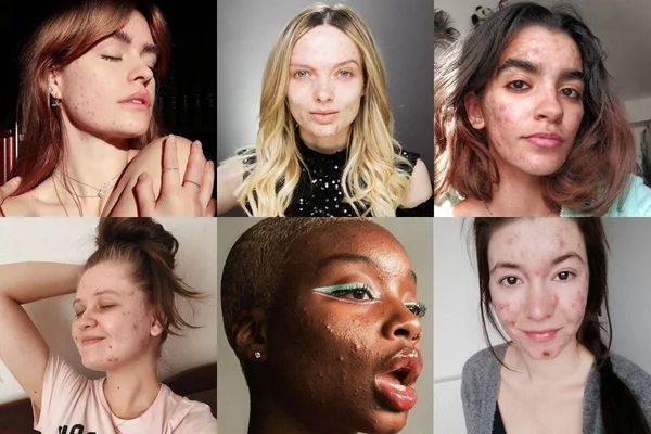 Conheça o #SkinPositivity, novo movimento de autoaceitação da web