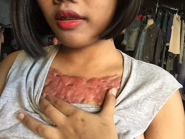 Garota relata momentos de dor ao remover tatuagem com método polêmico - imagem 11 Garota relata momentos de dor ao remover tatuagem com método polêmico - imagem 11