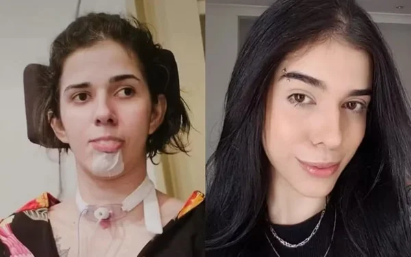 imagem colorida thais medeiros jovem teve reação alergica ao cheirar conserva de pimenta