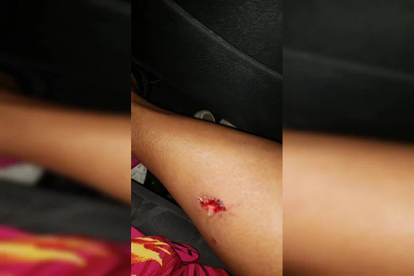 Buraco em perna de mulher após sofrer mordida - Metrópoles