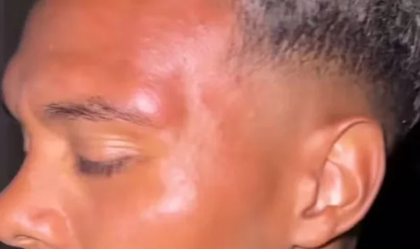 Imagem colorida de agressão sofrida por jogador do Nuremberg- Metrópoles