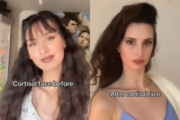 Cara de cortisol: entenda se estresse pode alterar o formato da face