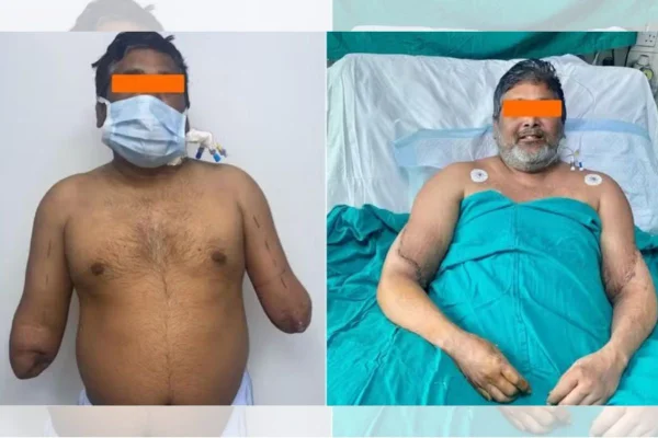 Duas fotos de homem antes e depois de transplante de braços - Metrópoles