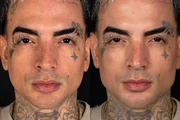 O cantor MC Guimê revelou que voltou ao consultório para atualizar a harmonização facial O cantor MC Guimê revelou que voltou ao consultório para atualizar a harmonização facial