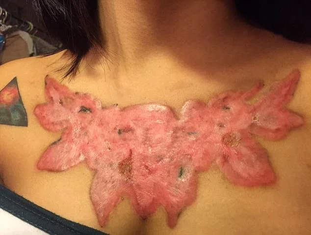 Garota relata momentos de dor ao remover tatuagem com método polêmico - imagem 15 Garota relata momentos de dor ao remover tatuagem com método polêmico - imagem 15