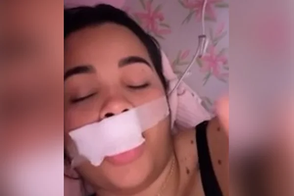 imagem colorida modelo tem parte do labio arrancado ao beijar cachorro - Metrópoles