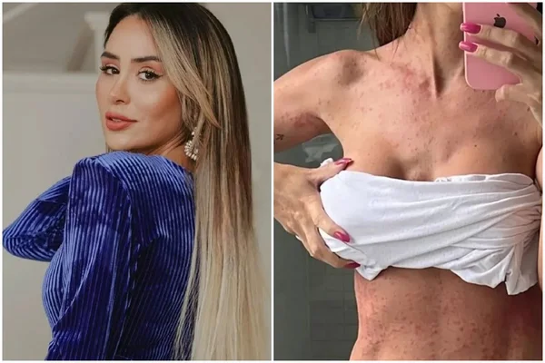 Ex-BBB recebe diagnóstico após vários dias com manchas na pele