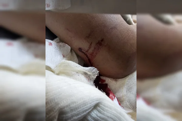 Imagem de um cotovelo ferido por um disparo de arma de fogo. Abaixo do braço, há uma contenção feita com gaze. Escorre sangue do membro