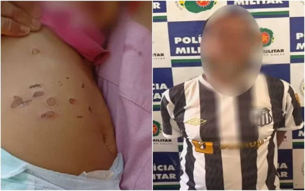 imagem colorida bebe queimadura de cigarro entorno df