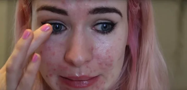 Youtuber de beleza chora ao falar de tratamento para acne severa