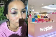 Foto de Letícia Oliveira, funcionária de quiosque da WePink, após agressão