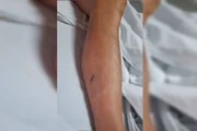 Panturrilha esfaqueada
