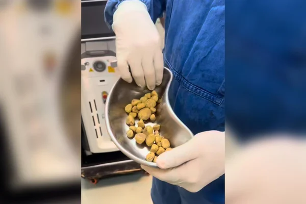 Imagem mostra médico segurando um recipiente com dezenas de cálculos urinários recém-retirados. Metrópoles