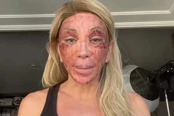 Maya Massafera choca ao aparecer com rosto ferido após peeling - Metrópoles