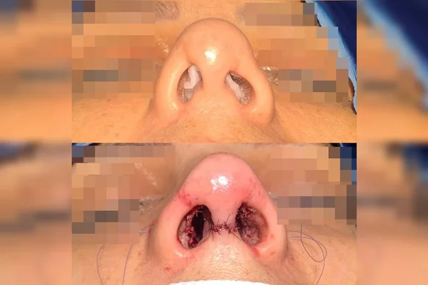 Rinoplastia