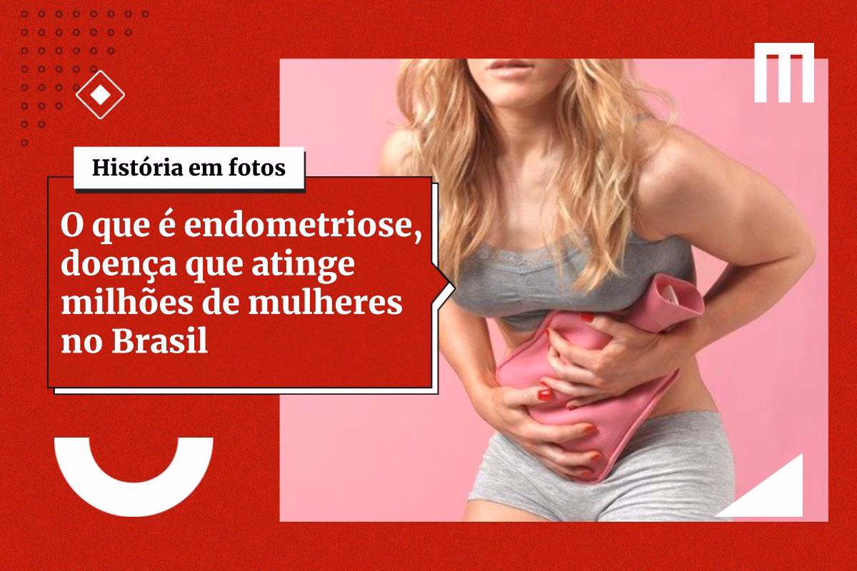 3-Cards_Galeria_de_Fotos-7-11 SUS passa a oferecer dois novos tratamentos para endometriose