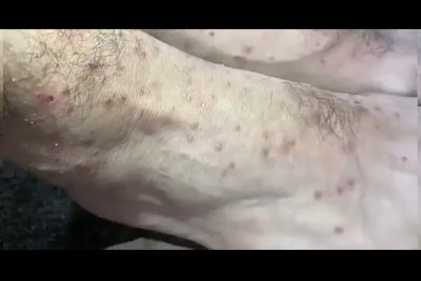 Participante de feijoada relata sintomas; três morreram de febre maculosa