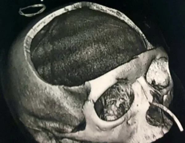 Mulher tem quase metade do crânio retirado em cirurgia