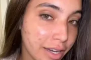 Vanessa Lopes mostra rosto com acnes e desabafa sobre saúde mental