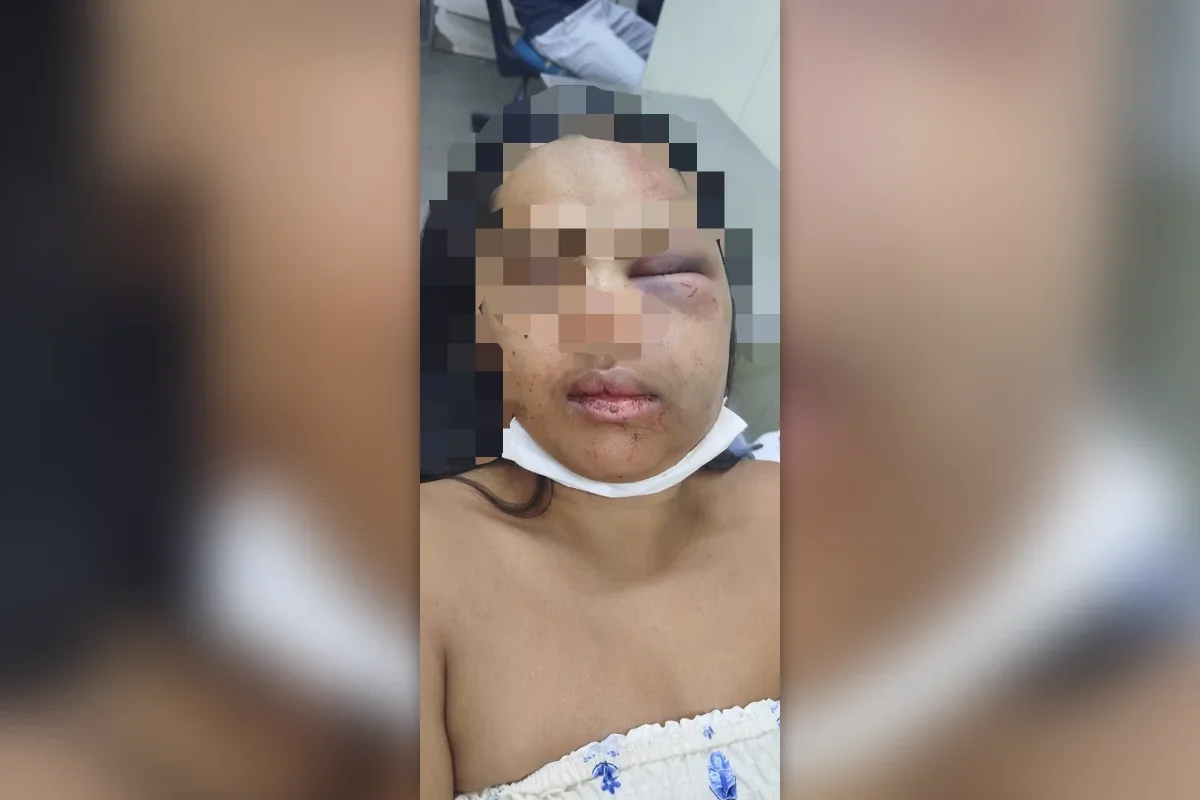 Já no chão, ela recebeu chutes no rosto, que a deformaram Já no chão, ela recebeu chutes no rosto, que a deformaram