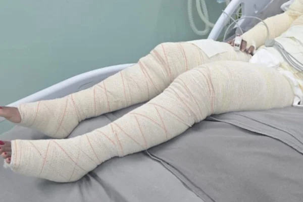 Mulher teve cerca de 80% do corpo queimado após ser atacada com álcool dentro de casa. Marido ficou foragido por 2 dias antes de ser preso - Metrópoles
