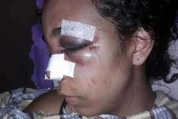 Mulher é agredida pelo ex com martelo e tem nariz quebrado