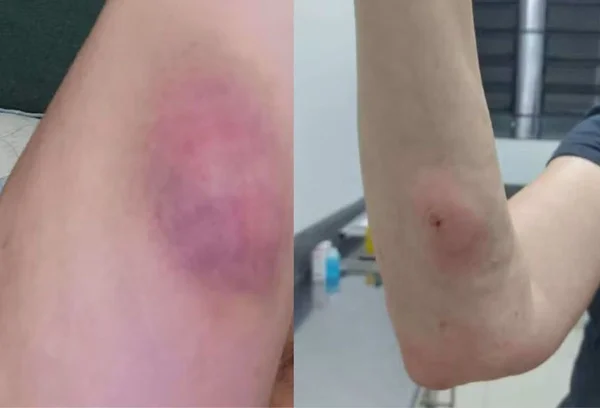 Imagem colorida de braço de mulher que recebeu injeção de veterinária