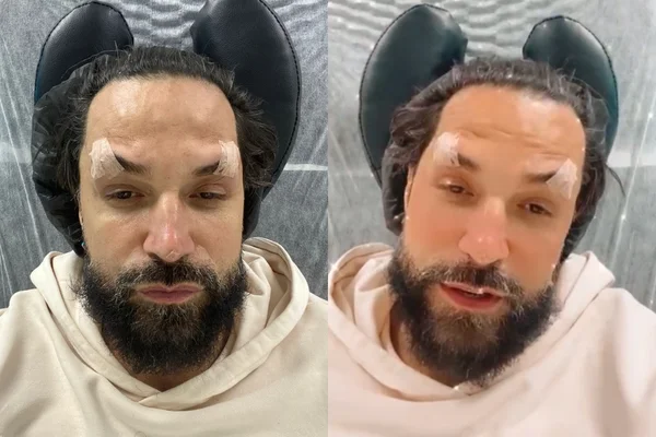 cantos após cirurgia facial