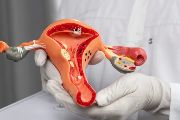 Foto colorida de médico segurando um modelo 3D do útero feminino - Câncer de colo do útero: é possível erradicar casos até 2030? - Metrópoles