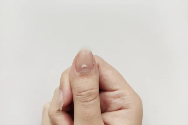 unhas com manchas brancas