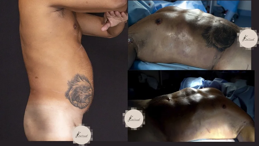 Gretchen e marido retocam Lipo HD Renuvion: clínica explica o procedimento (Divulgação) Gretchen e marido retocam Lipo HD Renuvion: clínica explica o procedimento (Divulgação)