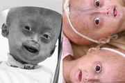 Morre Elis Carneiro Lima, menina de 5 anos diagnosticada com síndrome rara Morre Elis Carneiro Lima, menina de 5 anos diagnosticada com síndrome rara