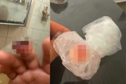 Dedo amputado Dedo amputado