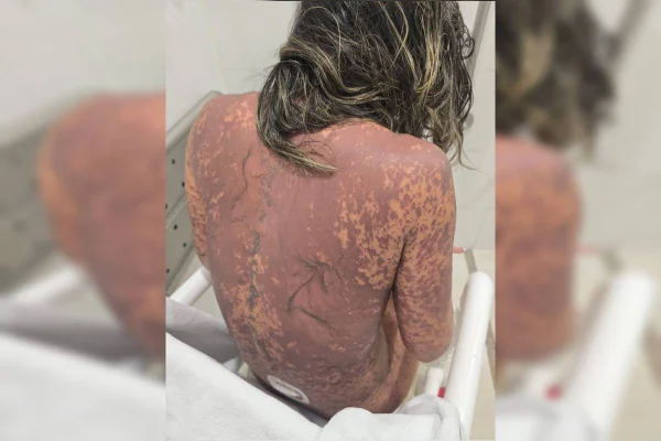 Costas de mulher queimadas