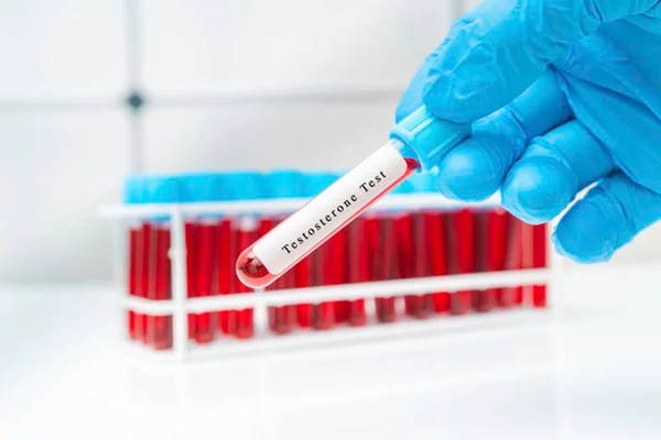 Mão calçada em luva azul segurando amostra de sangue para teste de testosterona