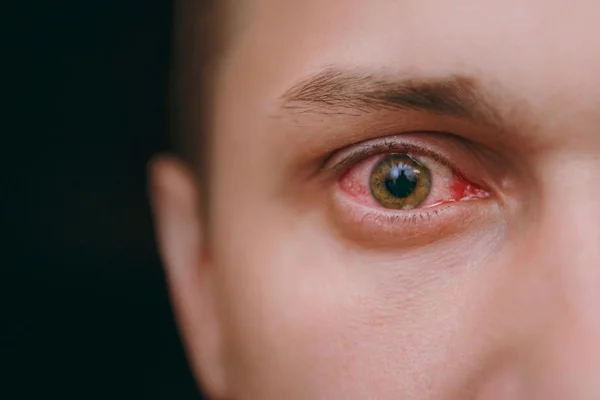 Casos de sífilis ocular no Brasil preocupam especialistas